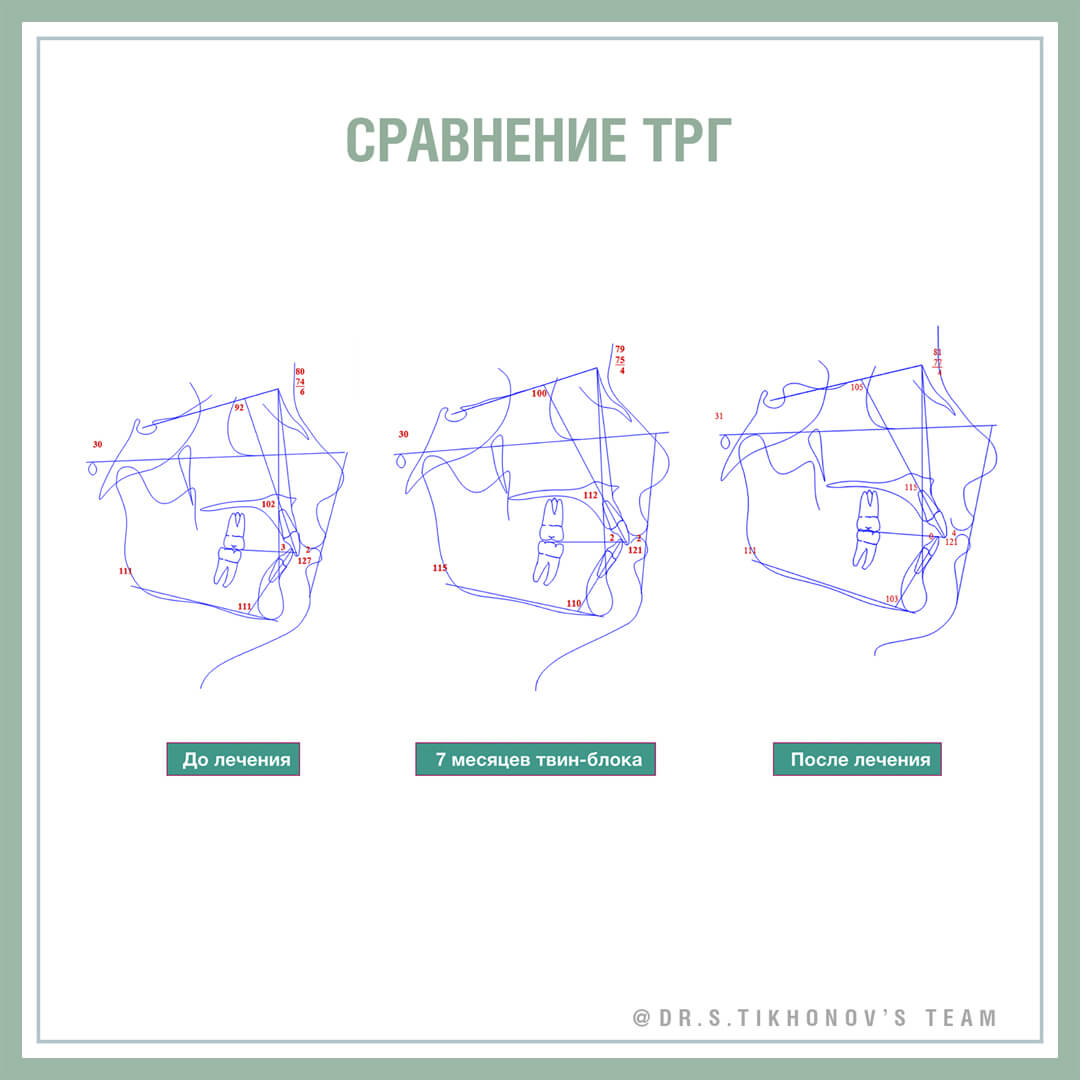 Коррекция II класса твин-блоком и брекет-системой. - интересно об  ортодонтии, имплантации и протезировании зубов